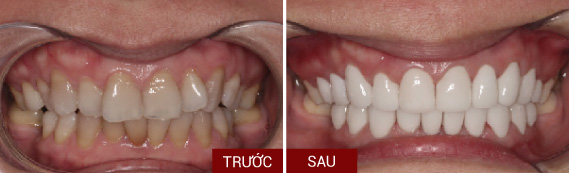 Răng xỉn màu, ngả vàng nặng, nhiễm kháng sinh tetracylin, không thể tẩy trắng 