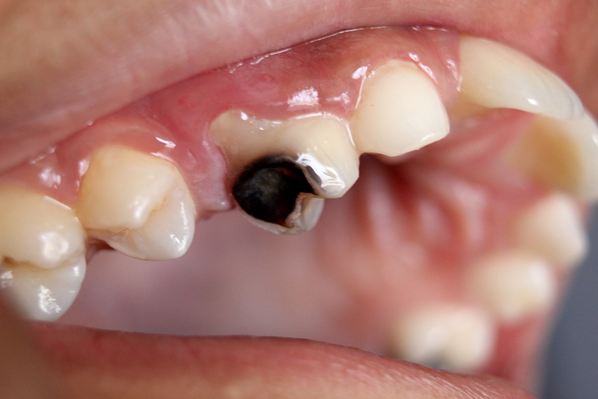 Sâu răng là bệnh lý răng miệng đặc biệt dễ gặp ở các độ tuổi